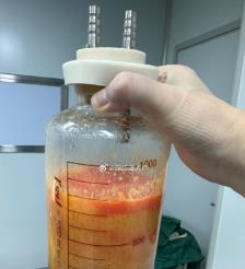 凉山水动力吸脂手术要做多久？